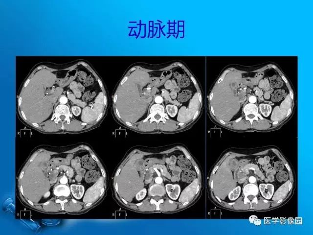 【病例】胆囊癌1例CT影像表现