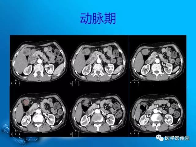 【病例】胆囊癌1例CT影像表现
