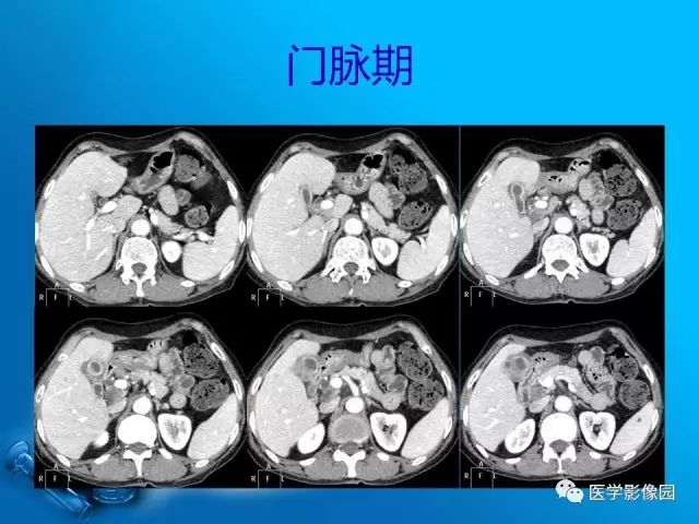 【病例】胆囊癌1例CT影像表现