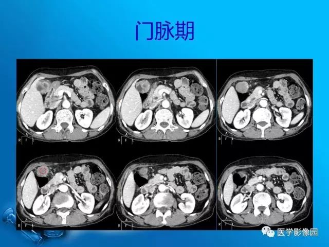 【病例】胆囊癌1例CT影像表现
