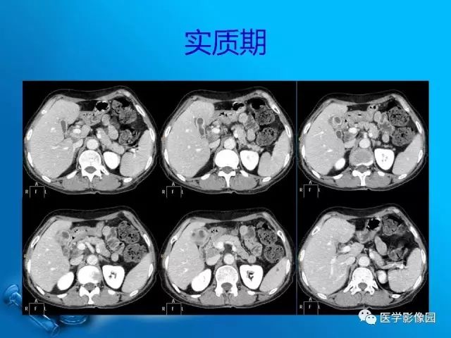 【病例】胆囊癌1例CT影像表现