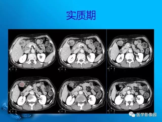 【病例】胆囊癌1例CT影像表现