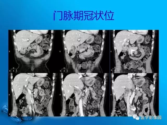 【病例】胆囊癌1例CT影像表现