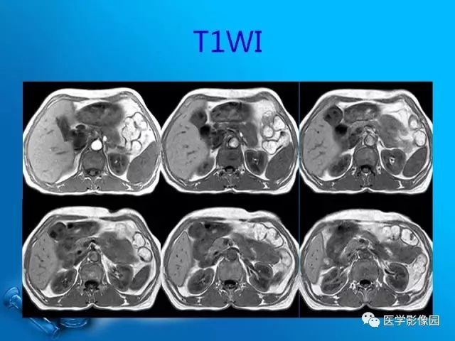 【病例】胆囊癌1例CT影像表现