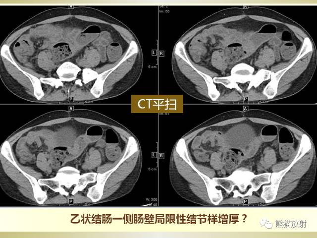【病例】乙状结肠子宫内膜异位症1例CT诊断思路分析