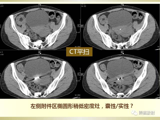 【病例】乙状结肠子宫内膜异位症1例CT诊断思路分析