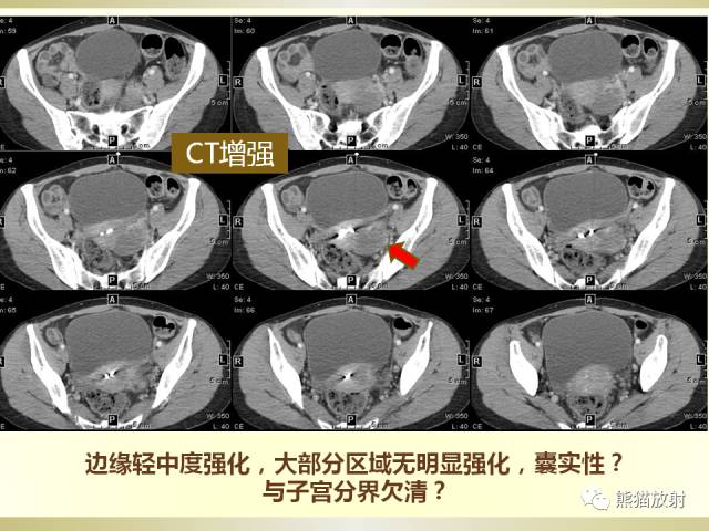 【病例】乙状结肠子宫内膜异位症1例CT诊断思路分析