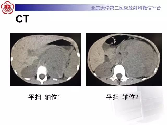 【病例】肾母细胞瘤1例CT影像表现