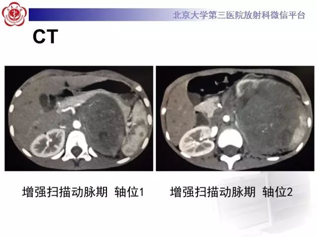 【病例】肾母细胞瘤1例CT影像表现