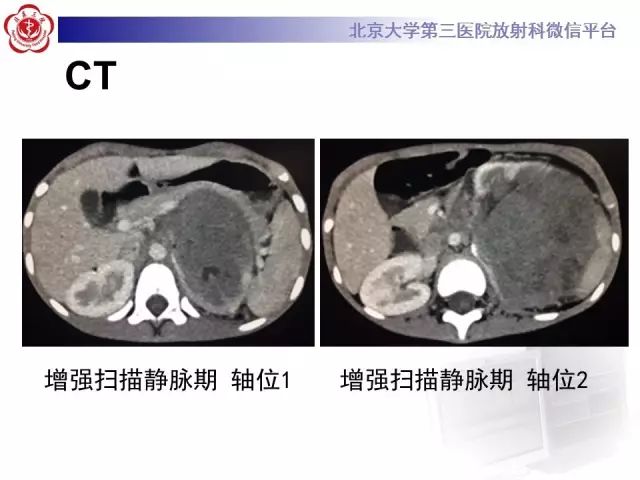 【病例】肾母细胞瘤1例CT影像表现