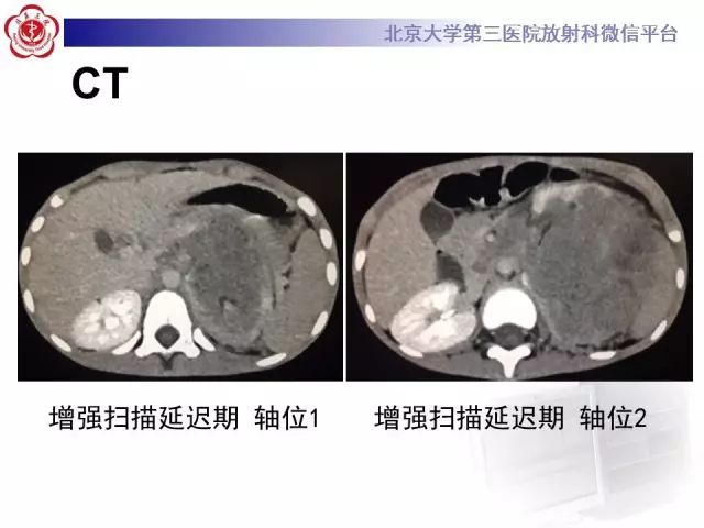 【病例】肾母细胞瘤1例CT影像表现