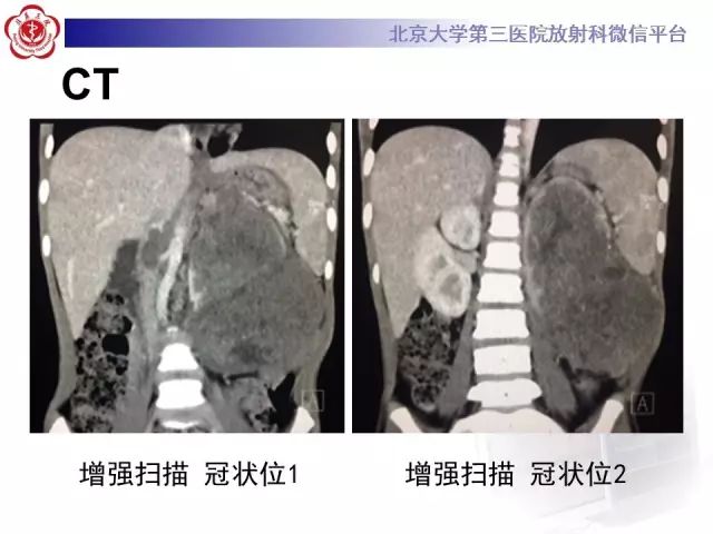 【病例】肾母细胞瘤1例CT影像表现