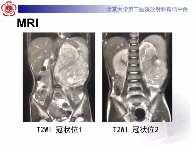 【病例】肾母细胞瘤1例CT影像表现