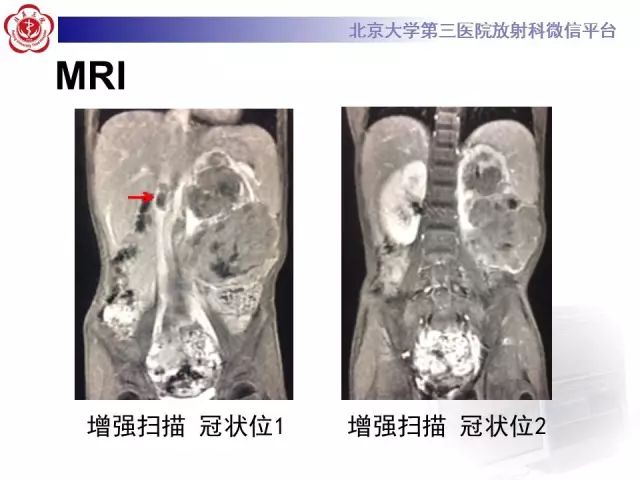【病例】肾母细胞瘤1例CT影像表现
