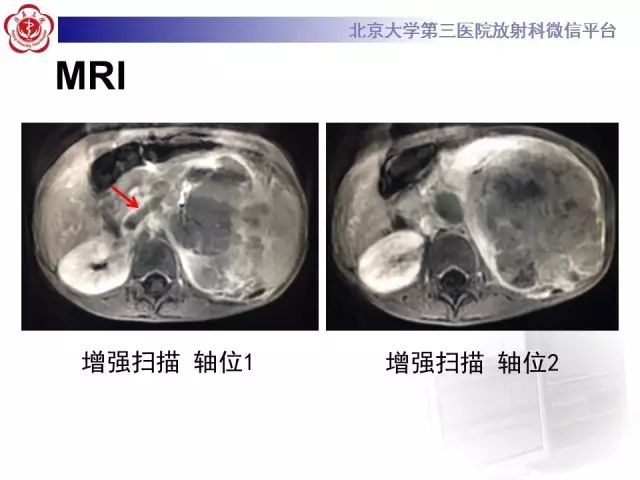 【病例】肾母细胞瘤1例CT影像表现