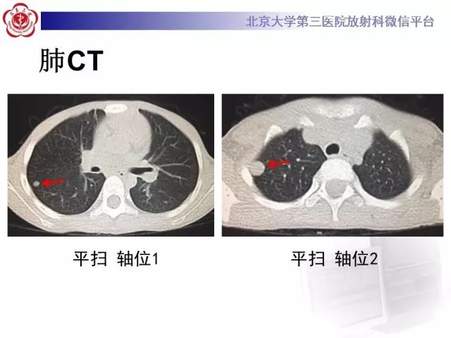 【病例】肾母细胞瘤1例CT影像表现