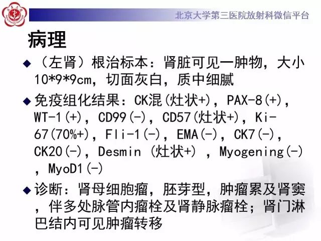 【病例】肾母细胞瘤1例CT影像表现