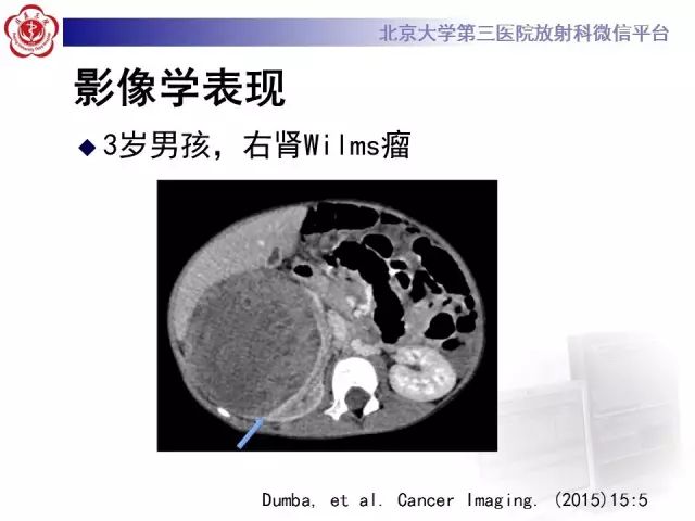 【病例】肾母细胞瘤1例CT影像表现