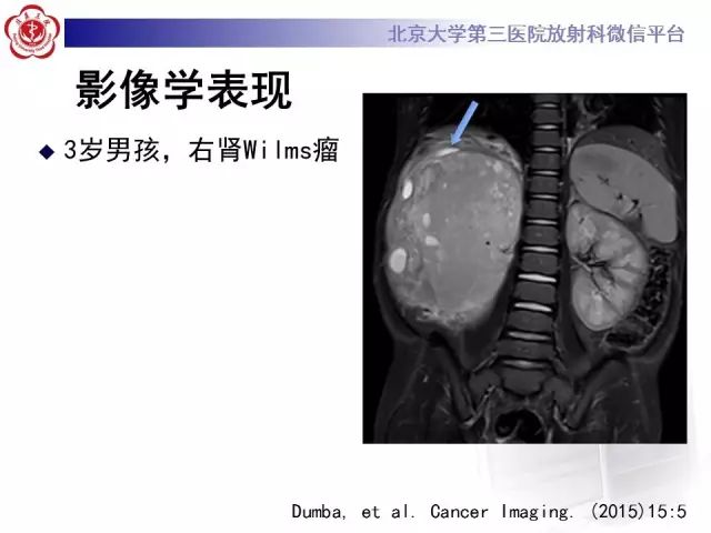 【病例】肾母细胞瘤1例CT影像表现
