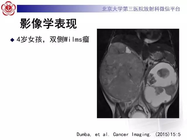 【病例】肾母细胞瘤1例CT影像表现