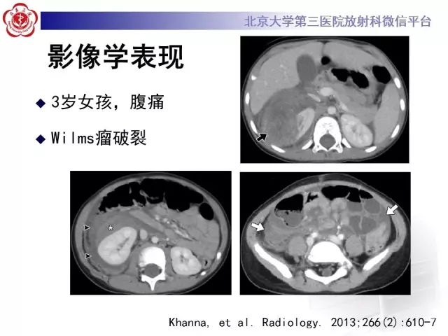 【病例】肾母细胞瘤1例CT影像表现