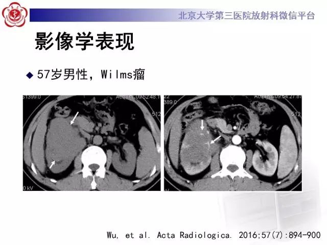 【病例】肾母细胞瘤1例CT影像表现