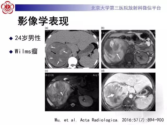 【病例】肾母细胞瘤1例CT影像表现