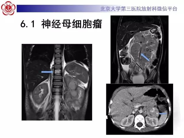 【病例】肾母细胞瘤1例CT影像表现