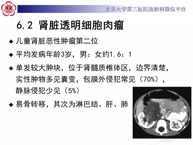【病例】肾母细胞瘤1例CT影像表现