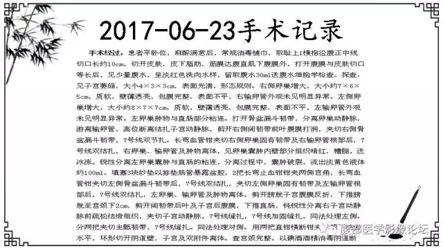 【病例】卵巢高级别浆液性癌1例CT及MR影像表现