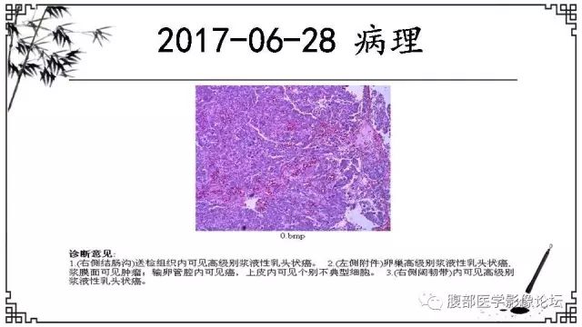 【病例】卵巢高级别浆液性癌1例CT及MR影像表现