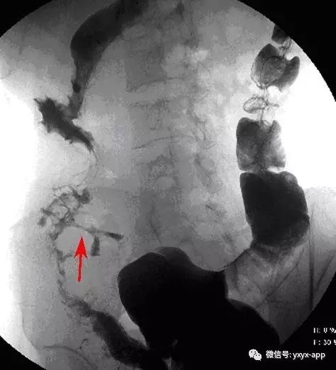 【病例】克罗恩病1例X线钡灌肠影像诊断分析