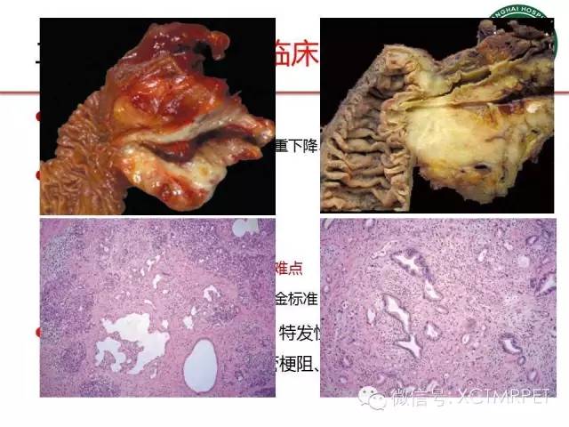 【PPT】肿块性胰腺炎影像诊断和鉴别诊断