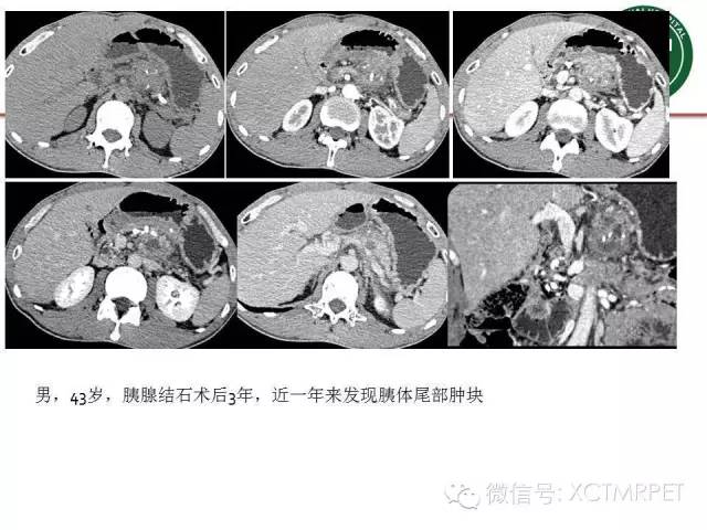 【PPT】肿块性胰腺炎影像诊断和鉴别诊断