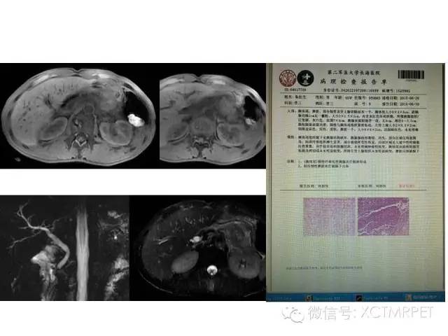 【PPT】肿块性胰腺炎影像诊断和鉴别诊断