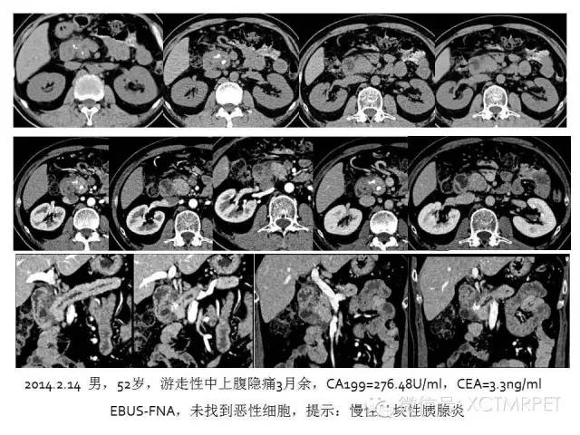 【PPT】肿块性胰腺炎影像诊断和鉴别诊断