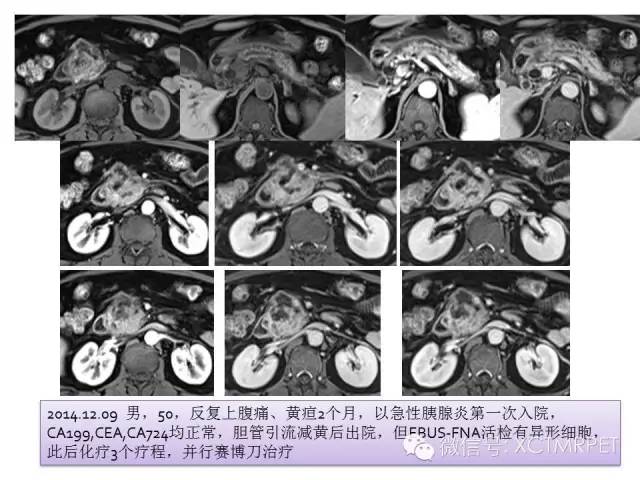 【PPT】肿块性胰腺炎影像诊断和鉴别诊断