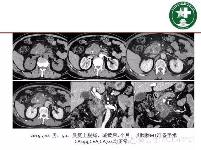 【PPT】肿块性胰腺炎影像诊断和鉴别诊断