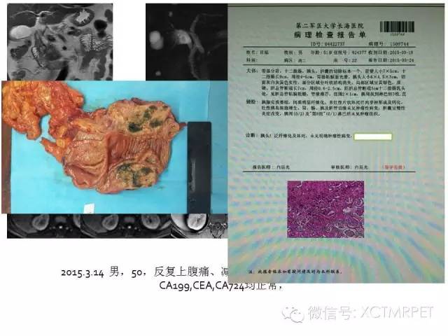 【PPT】肿块性胰腺炎影像诊断和鉴别诊断