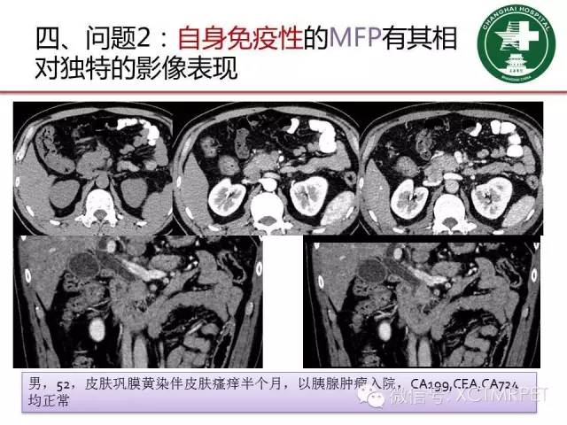 【PPT】肿块性胰腺炎影像诊断和鉴别诊断
