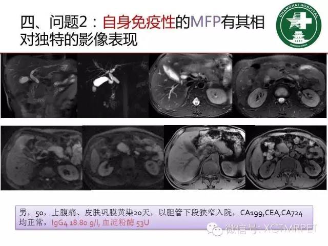 【PPT】肿块性胰腺炎影像诊断和鉴别诊断