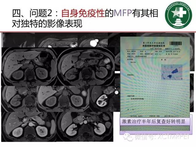 【PPT】肿块性胰腺炎影像诊断和鉴别诊断