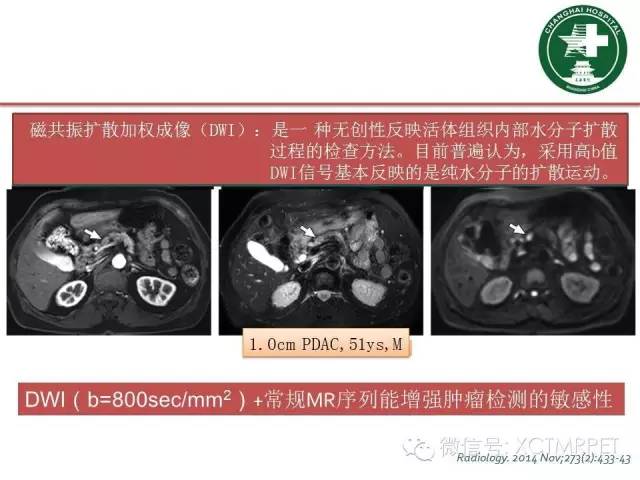 【PPT】肿块性胰腺炎影像诊断和鉴别诊断