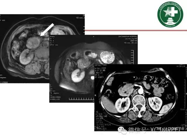 【PPT】肿块性胰腺炎影像诊断和鉴别诊断
