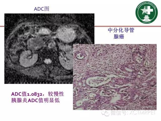 【PPT】肿块性胰腺炎影像诊断和鉴别诊断