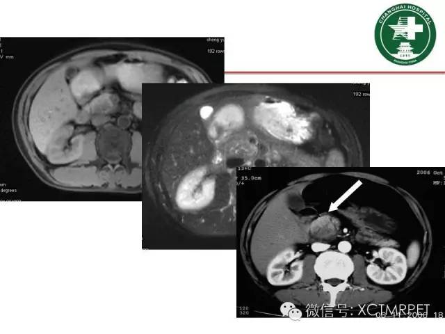 【PPT】肿块性胰腺炎影像诊断和鉴别诊断