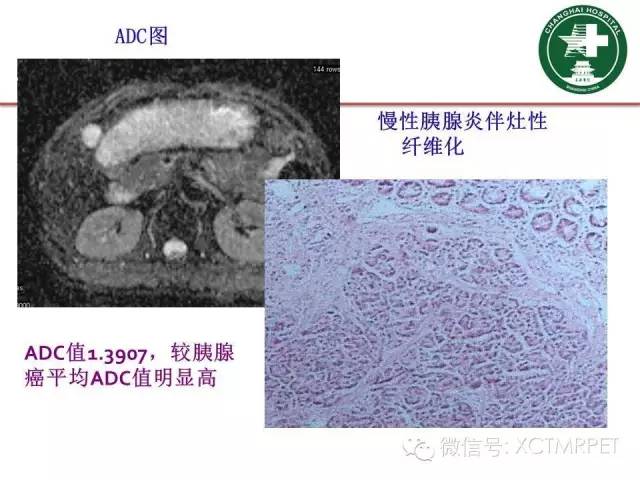 【PPT】肿块性胰腺炎影像诊断和鉴别诊断