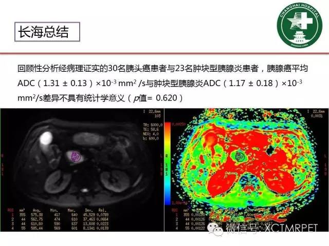 【PPT】肿块性胰腺炎影像诊断和鉴别诊断