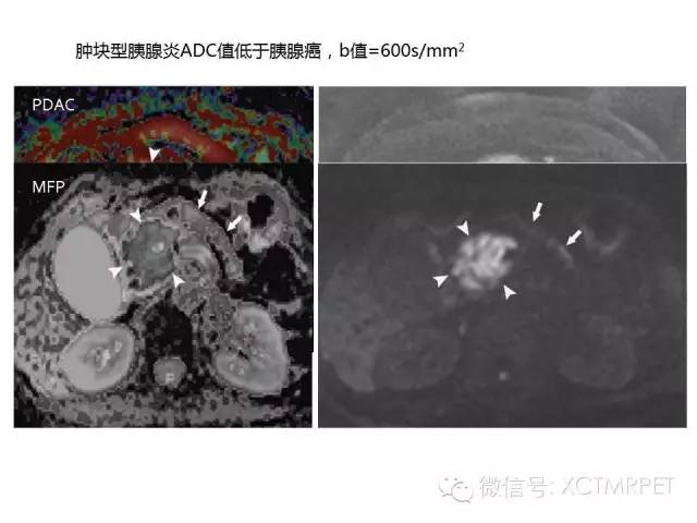 【PPT】肿块性胰腺炎影像诊断和鉴别诊断