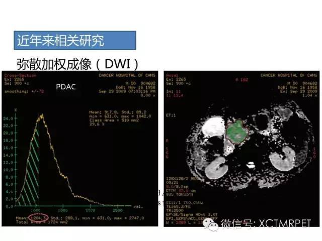 【PPT】肿块性胰腺炎影像诊断和鉴别诊断